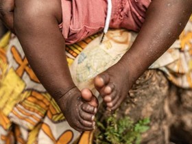 世卫拉响最高警报 猴痘疫情现在怎么样了?