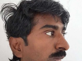 印度男子1岁时摔跤磕到下巴 38年张不了嘴吃流食