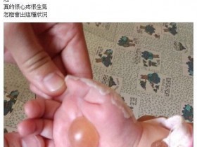 女婴看病被医生用手电筒烫起大水泡:为找血管(图)
